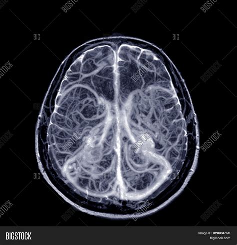 Magnetic Resonance Venographymrv Brain Of Veins In Human Headmedical
