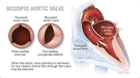 Mayo Clinic Q And A What Is A Bicuspid Aortic Valve Mayo Clinic News Network