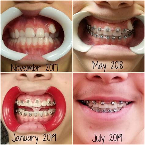 How Long Will It Take For Braces To Work Reverasite
