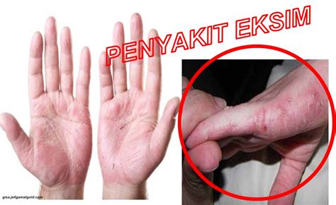 Gatal pada bintik merah di kulit akan menyebabkan ketidaknyamanan yang dapat mengganggu aktivitas dan penampilan. Cara Mudah Menghilangkan Gatal Eksim Pada Telapak Tangan ...
