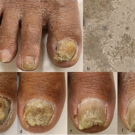 Treatment Outcome With Fosravuconazole For Onychomycosis Request Pdf