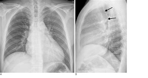 A Posteroanterior X Ray Of The Chest Shows Cardiomegaly And Lymph Node