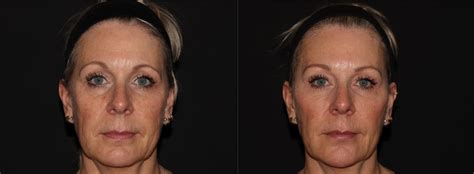 Facial Rejuvenation With Botox Cosmetic® And JuvÉderm® Dermal Filler