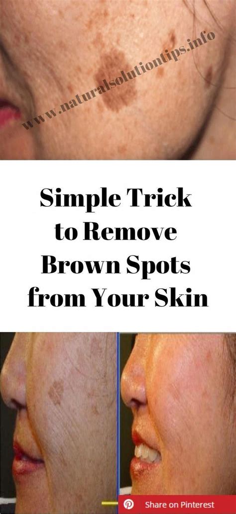How You Can Take Away Brown Spots On Face Smallbrownspotsonface