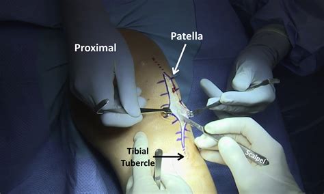 Open Patellar Tendon Tenotomy Debridement And Repair Technique Augmented With Platelet Rich