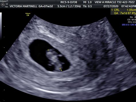 7 Week Ultrasound Identical Twins