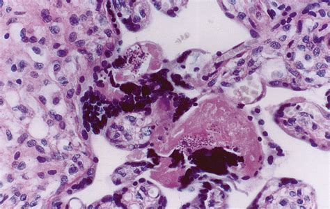 Histoplasmosis In Pregnancy Case Series And Report Of Transplacental