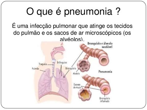 Neste vídeo vamos dar continuidade ao tema das infecções respiratórias agudas, com a pneumonia bacteriana. Pneumonia