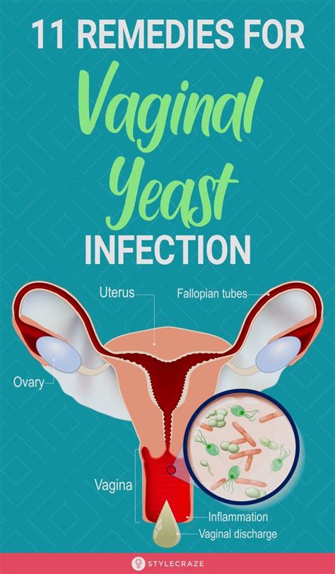 Pin By Adlaizloke On Health Yeast Infection Cure Yeast Infection