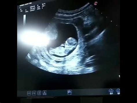 11 minggu kehamilan - YouTube