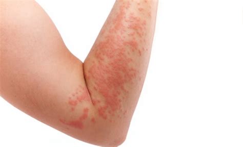 Aloe Vera For Skin Skin Diseases And Disorders How To Cure Skin