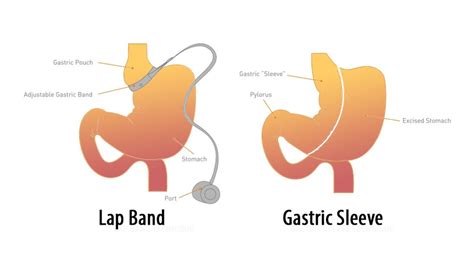 Lap Band Surgery How It Works Weight Loss Surgery