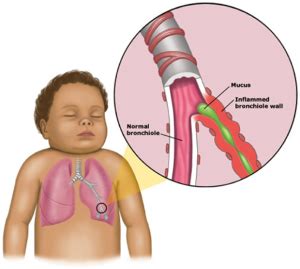 Pediatra Mallorca Dr Esteban Keklikian Diagnostico Y Tratamiento Bronquiolitis Infantil
