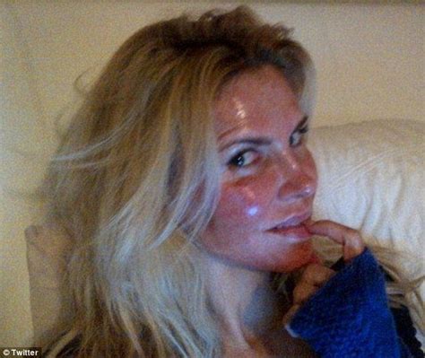 Brandi Glanville Reveals Her Burnt Face After Skin Discoloration Treatment