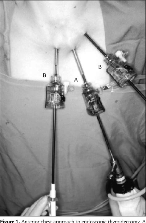Figure 1 From Total Endoscopic Thyroidectomy Semantic Scholar