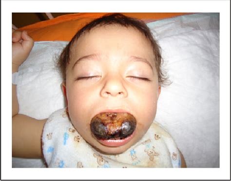 Figure 1 From Successful Treatment Of Macroglossia Due To Lymphatic