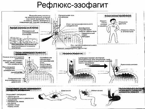 Эзофагит лечение и диета Рефлюкс Эзофагит Симптомы И Лечение Диета – Telegraph Рефлюкс Эзофагит Симптомы И Лечение Диета – Telegraph Эзофагит лечение и диета