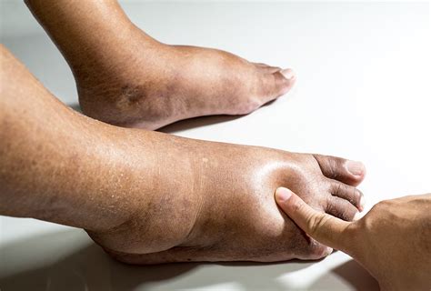 Edema Stages Types Causes Treatment Risks Emedihealth 2023