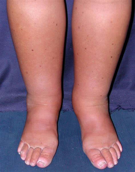 What Is Lymphedema The Cancer Help Blog