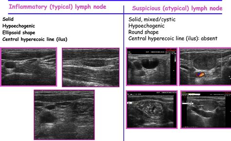 Malignant Thyroid Nodules Ultrasound