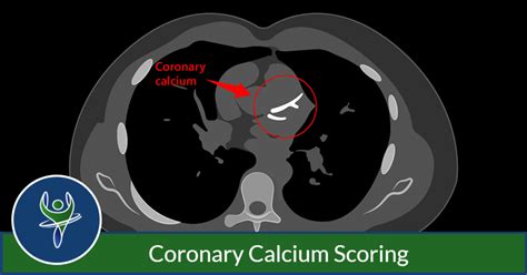 Coronary Calcium Scoring Capitol Imaging Services