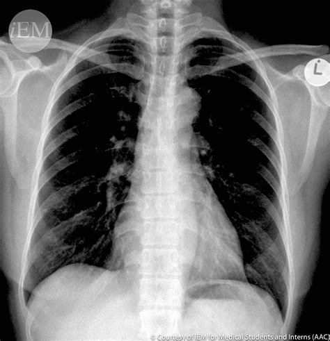 3374 Pa Chest X Ray Overexposure Emergency Medicine Clinical