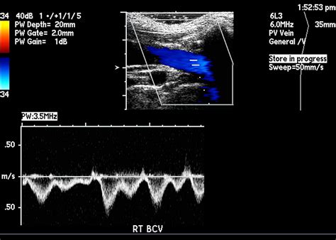 Arterial Waveforms Ultrasound
