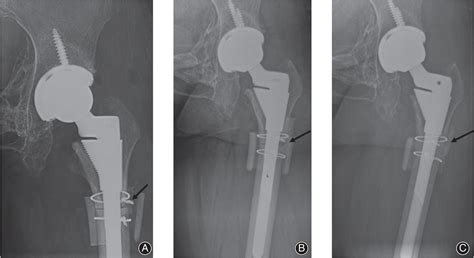 Subtrochanteric Osteotomy In Direct Anterior Approach Total Hip