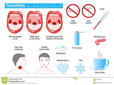 Tonsillitis Infographic Stock Vector Illustration Of Healthcare 88485521