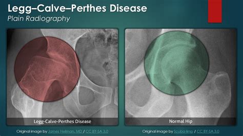 Legg Calve Perthes Disease Plain Radiography Youtube