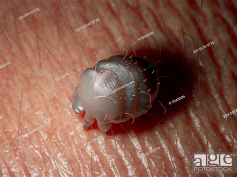 D Rendered Medically Accurate Illustration Of A Scabies Mite On Human