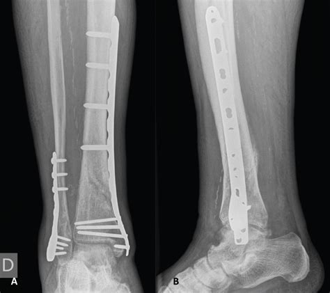 Fixation Of A Distal Diaphyseal Tibia Fracture With Neurovascular
