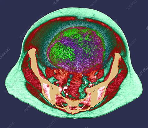 Ovarian Cancer Ct Scan Stock Image M8500543 Science Photo Library