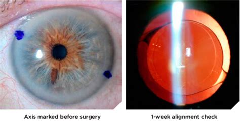 Toric Lens Implants Pacific Cataract And Laser Institute For Doctors