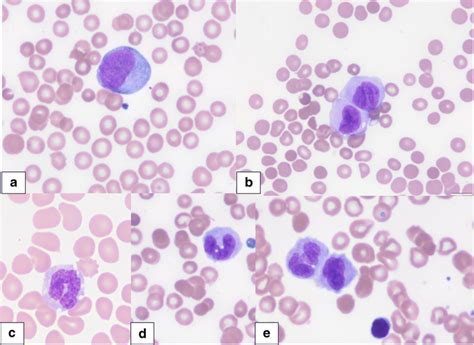 Monocytic Morphology A Monoblasts B Promonocytes C Mature Monocytes De