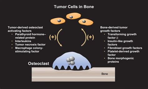 Skeletal Complications Across The Cancer Continuum Bone Metastases And
