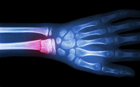 A promising new strategy to help broken bones heal faster | Penn Today
