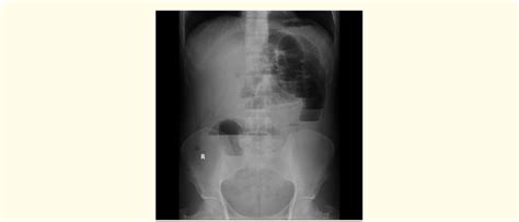 A Abdominal X Ray Showing Multiple Air Fluid Levels Delineating A