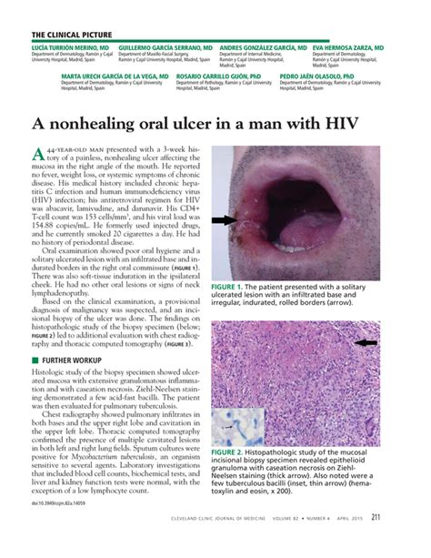 A Nonhealing Oral Ulcer In A Man With Hiv Cleveland Clinic Journal Of