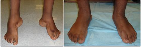 Clubfoot Surgery Adult And Pediatric Ilizarov — Foot Ankle Surgery
