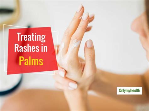 Experiencing Palm Rashes Heres Are Some Treatment Tips From