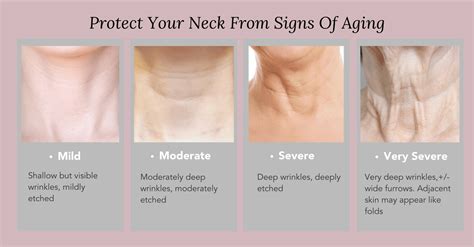 How To Treat Reduce And Prevent Neck Wrinkles And Sagging