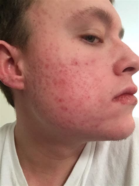 Acne Still Bad After Accutane Prescription Acne Medications By RDPhillips Acne Org