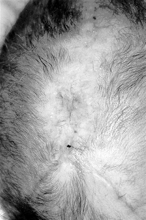 Scalp Aplasia Cutis Congenita Presenting With Sagittal Sinus Hemorrhage