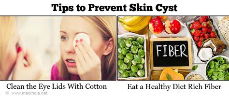 Skin Cyst Types Risk Factors Causes Symptoms Complications