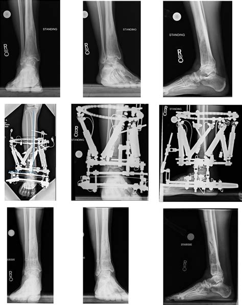Ankle Distraction Arthroplasty Ada A Brief Review And Technical