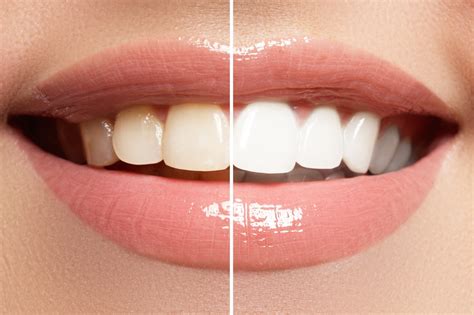 7 Simple Ways To Whiten Your Teeth For A Brilliant And Beautiful Smile