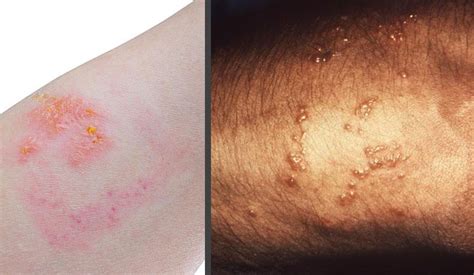 Pictures Of Skin Rashes Lovetoknow