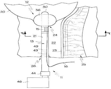Intraurethral Pressure Monitoring Assembly And Method Of Treating
