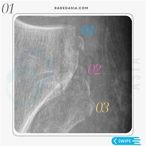 3 Lateral Knee Fractures Segond Arcuate And Lateral Fibular Fractures